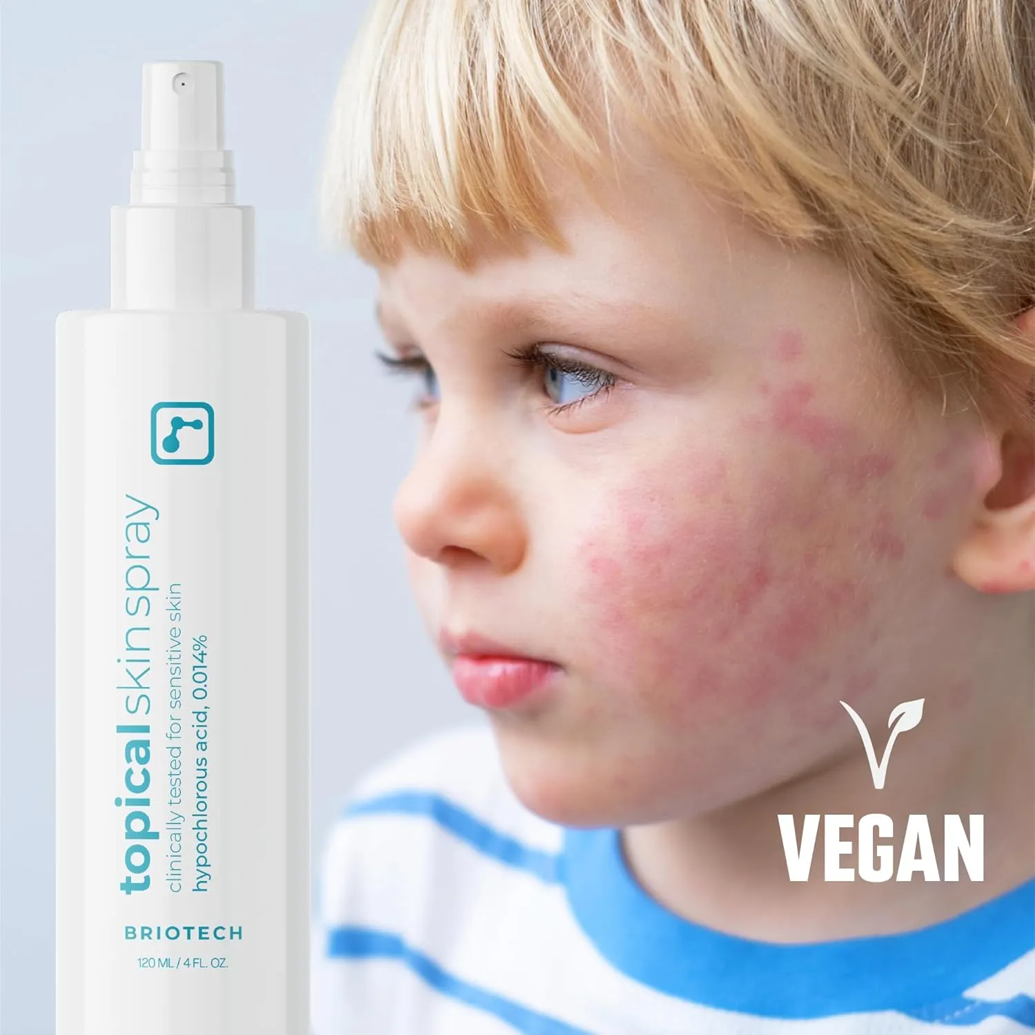 BRIOTECH Topical Skin Spray, Hypochlorous Acid Spray for Sensitive Skin, HOCl Facial Mist, Full Body Support Against Irritation, Calm Redness, Soothe Foot & Scalp, 8 oz (1 Pack)